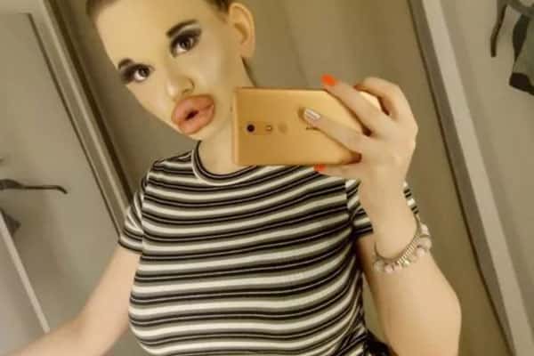 Девушка, потратившая 2,4 млн рублей на увеличение губ, распугала всех мужчин