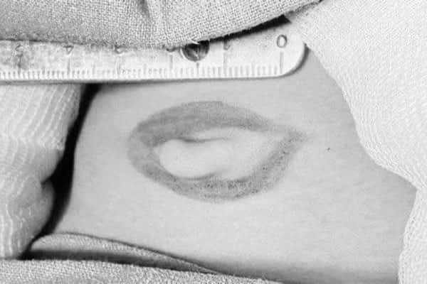 Подмосковные хирурги удалили «жабры» четырёхлетнему ребёнку