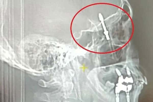 Зубная драма: как имплант врача оказался в мозге пациента