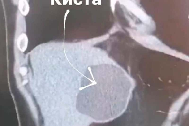 В Долгопрудном мужчине удалили 10-сантиметровые кисты с ленточными червями