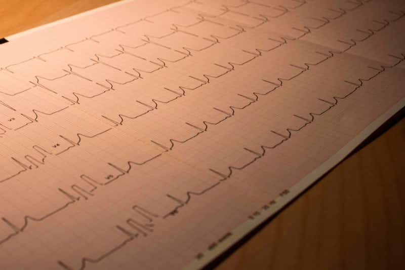 Врач назвала ранние признаки инфаркта