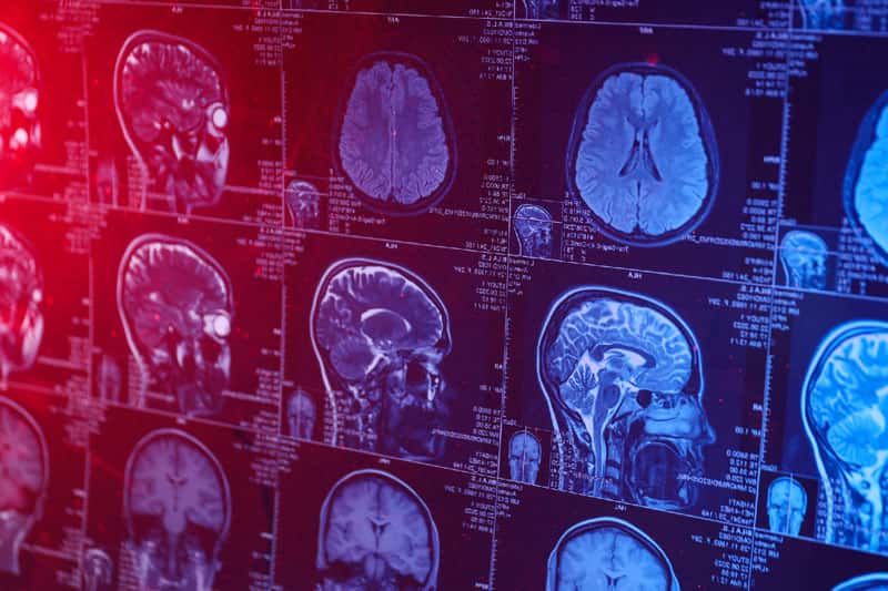Врач-онколог о симптомах раковой опухоли мозга: на что обратить внимание?