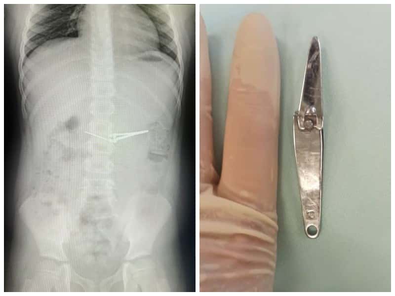 Съел щипцы: в Уфе врачи вытащили острый предмет из желудка шестилетнего мальчика