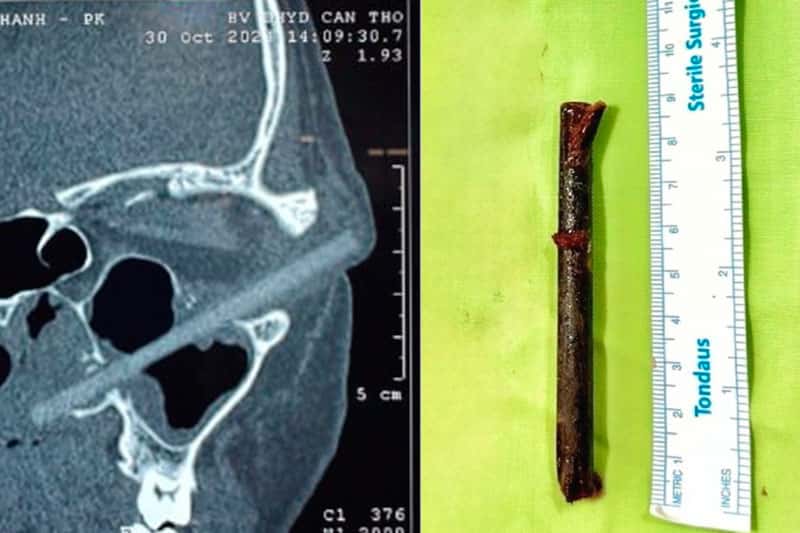 Во Вьетнаме мужчина три недели ходил с 9-сантиметровой палочкой в глазу и не замечал этого