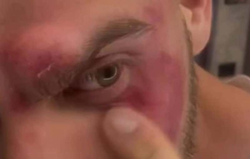 Фитнес-тренер в Мытищах получил травму лица от штанги весом 100 кг