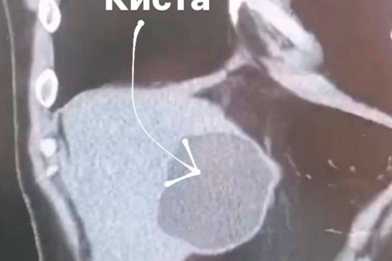 В Долгопрудном мужчине удалили 10-сантиметровые кисты с ленточными червями | Подмосковные врачи спасли мужчину с огромными кистами паразитов в печени