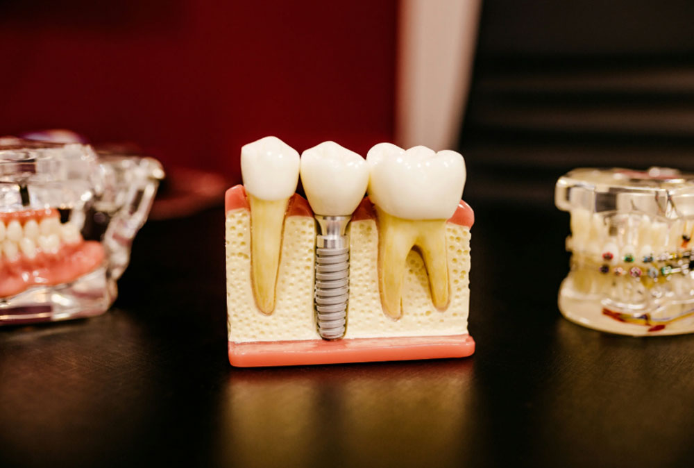 Новый имплант без боли и риска осложнений: как это работает | Учёные создали биоматериал, который изменит зубные импланты навсегда Новый имплант без боли и риска осложнений: как это работает | Учёные создали биоматериал, который изменит зубные импланты навсегда