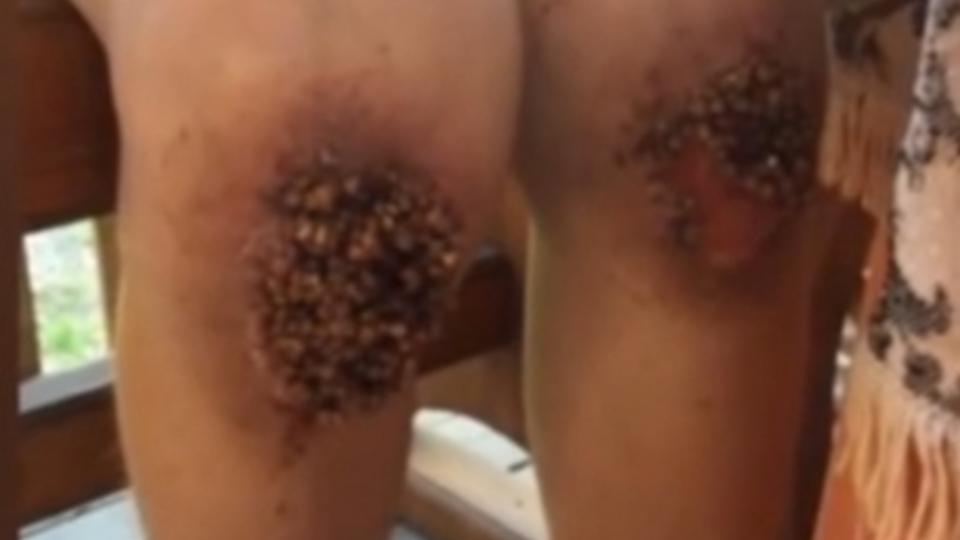 В Омске мальчику в колени вросла гречка из-за частых наказаний отчима