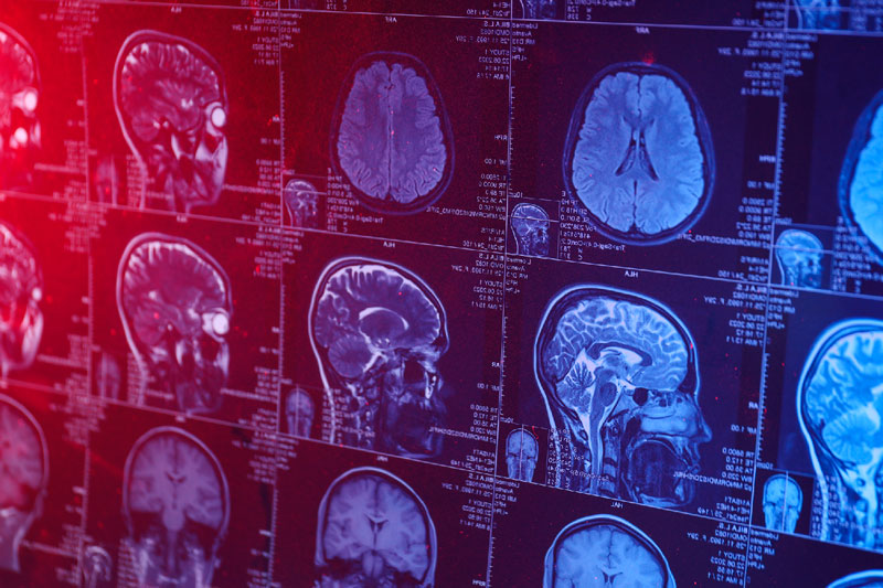 Врач-онколог о симптомах раковой опухоли мозга: на что обратить внимание? | Онколог Черёмушкин перечислил первые симптомы опухоли мозга